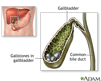 Mitigate gall stones