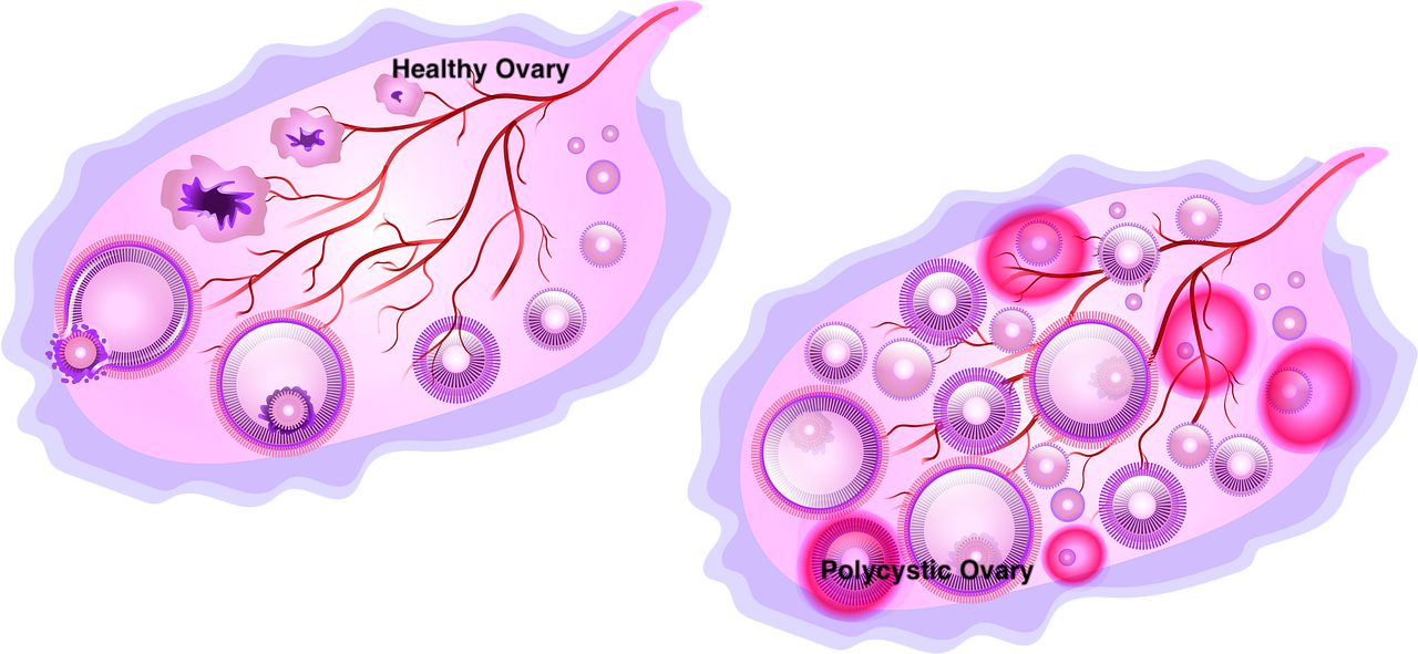 PCOS: Frequently Asked Questions