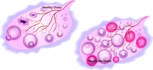PCOS: Frequently Asked Questions