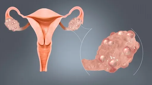 Managing PCOS