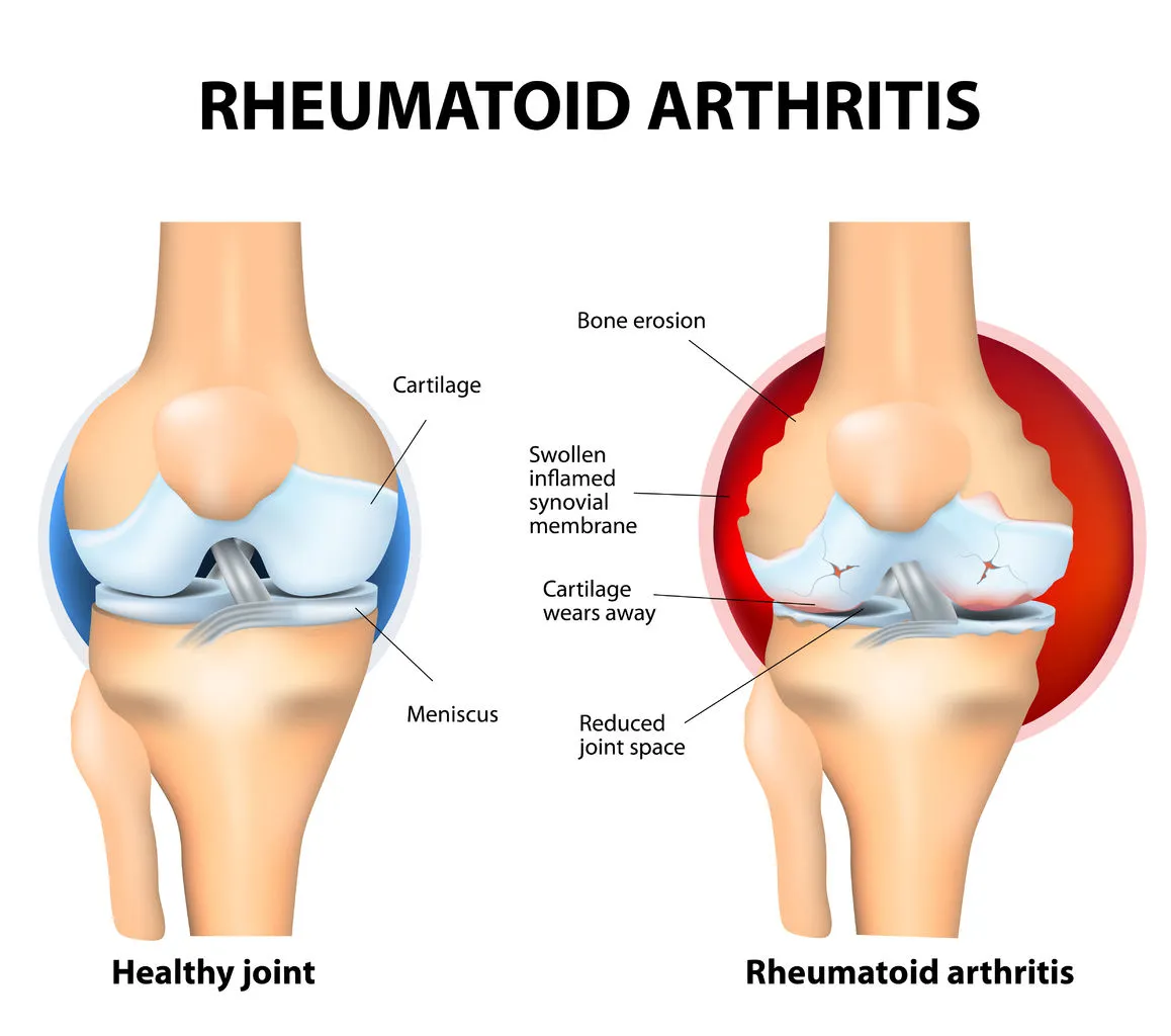 Rheumatoid Arthritis: Can Diet Help?